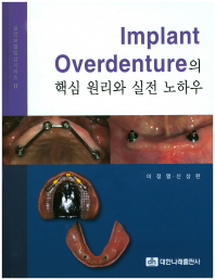 Implant Overdenture의 핵심 원리와 실전 노하우